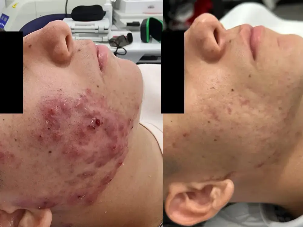 Paciente recibiendo tratamiento con Láser Fotona para el acné inflamatorio.