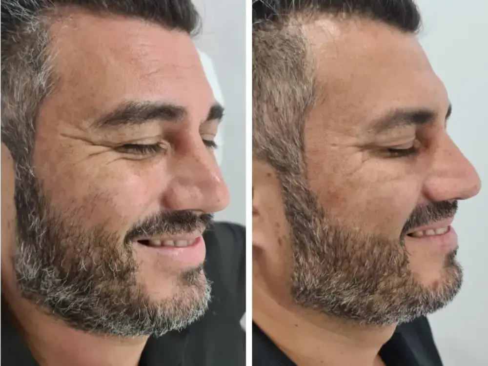 Antes y después de un hombre con barba tras recibir tratamiento con toxina botulínica para reducir arrugas en el área de los ojos.